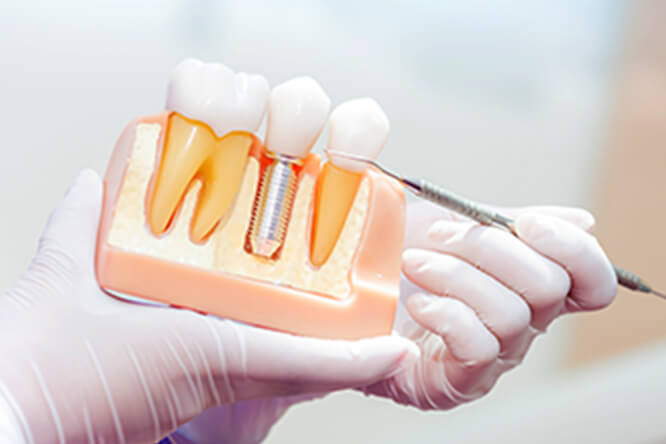 天然の歯を残すために インプラント治療と歯周病