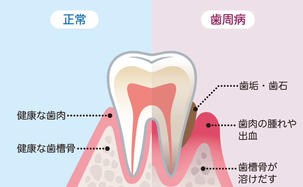 歯周病は気づかないうちに骨を溶かすことも