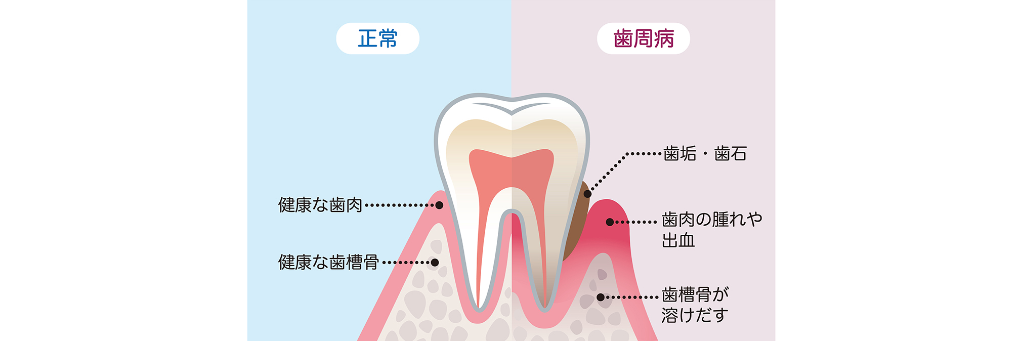 歯周病は気づかないうちに骨を溶かすことも